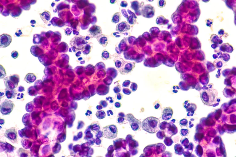 Beljakovinske bodice COVIDa  pomagajo rakavim celicam preživeti in se upreti kemoterapiji: Univerza Brown: predtisk poročila
